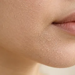 Hình minh họa da khô